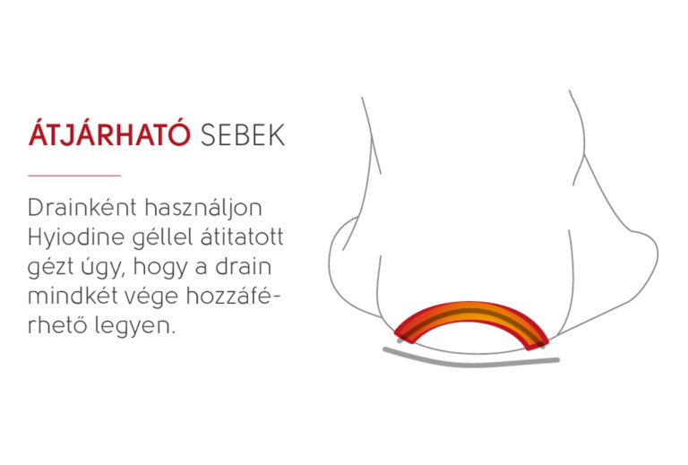 átjárható sebek