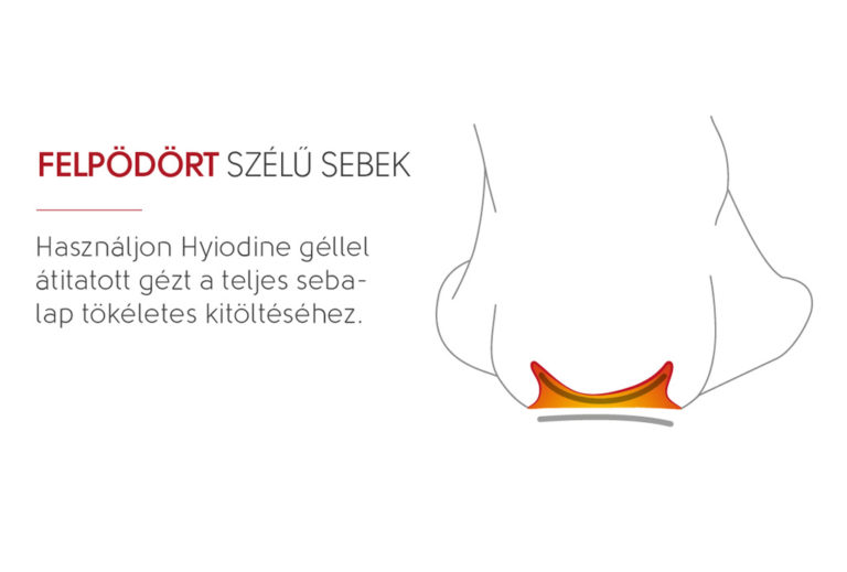 felpördült szálű sebek