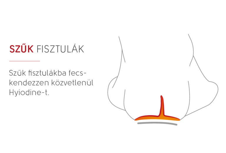 szűk fisztulák