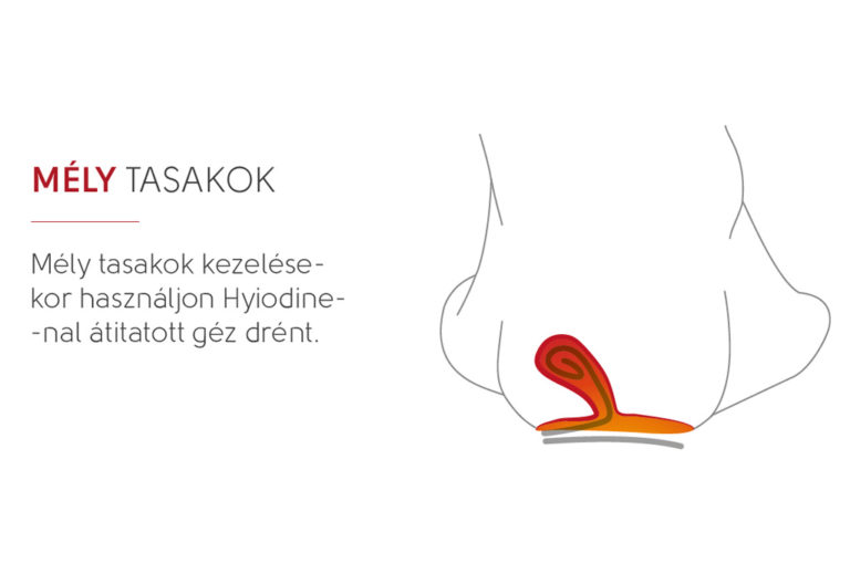 mély tasakok
